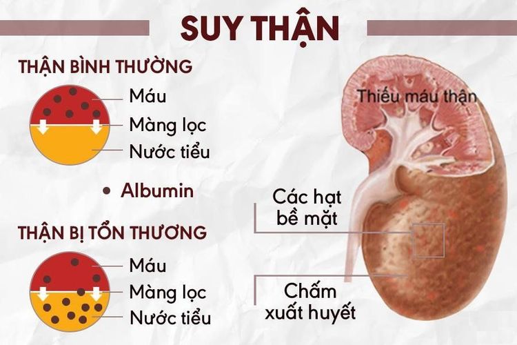 
Biểu hiện suy thận
