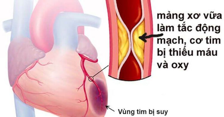 
Nguyên nhân gây nhồi máu cơ tim
