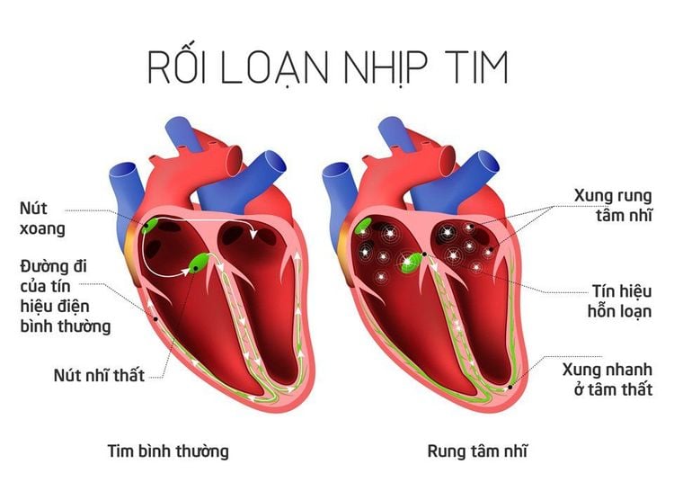 
Rối loạn nhịp tim có thể xảy ra trong quá trình gây mê nội khí quản
