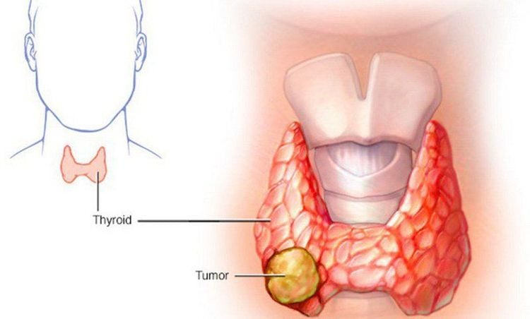 
Dấu hiệu của u tuyến giáp ác tính
