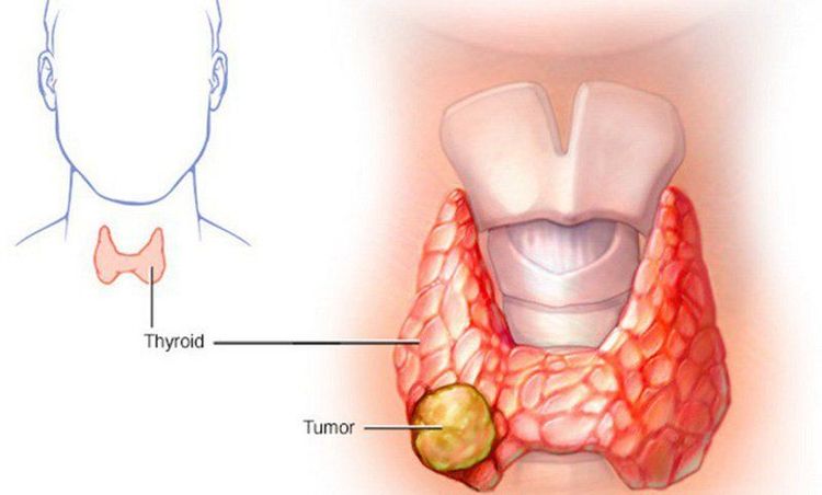 
Dấu hiệu của u tuyến giáp ác tính

