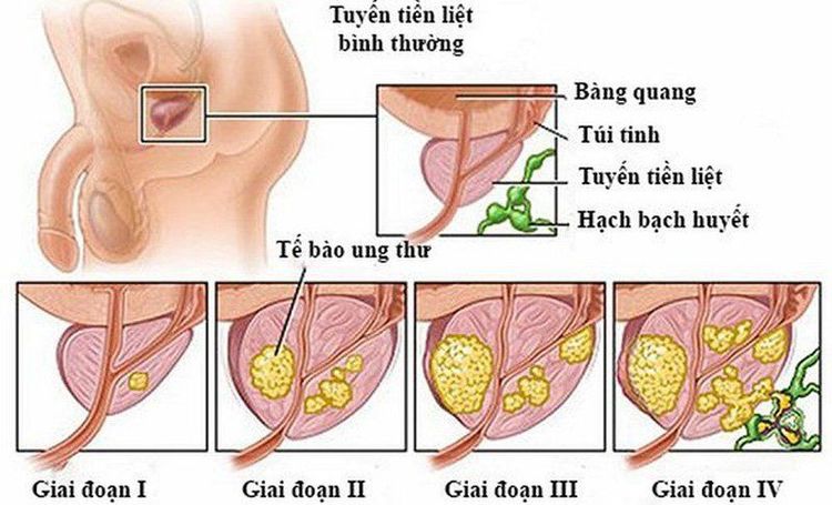 
Ung thư tuyến tiền liệt gây ra tình trạng xuất tinh ra máu
