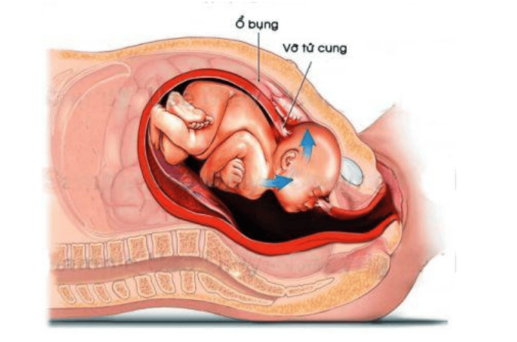 
Vỡ tử cung trong chuyển dạ là một tai biến trong sản khoa
