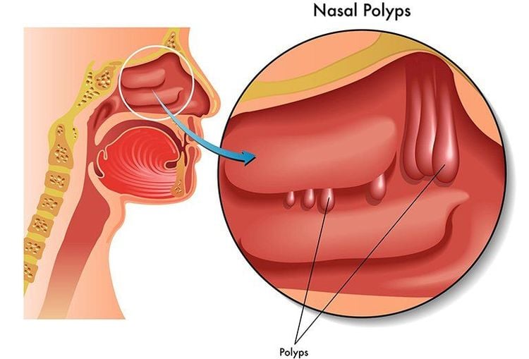 
Polyp mũi là các khối tròn giống nang nhỏ ở trong mũi
