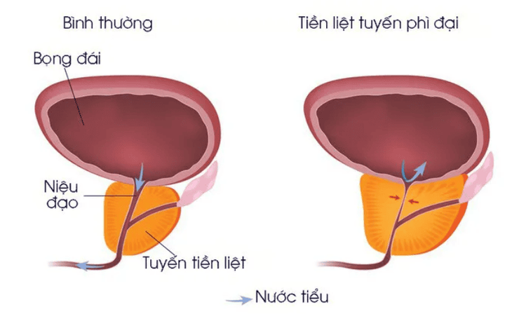 
Phì đại tiền liệt tuyến
