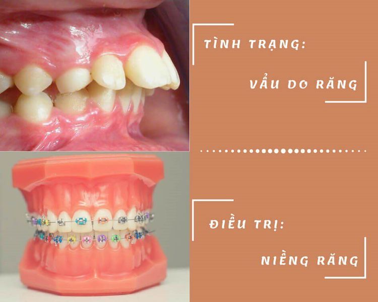 
Chữa răng vẩu bằng phương pháp niềng răng
