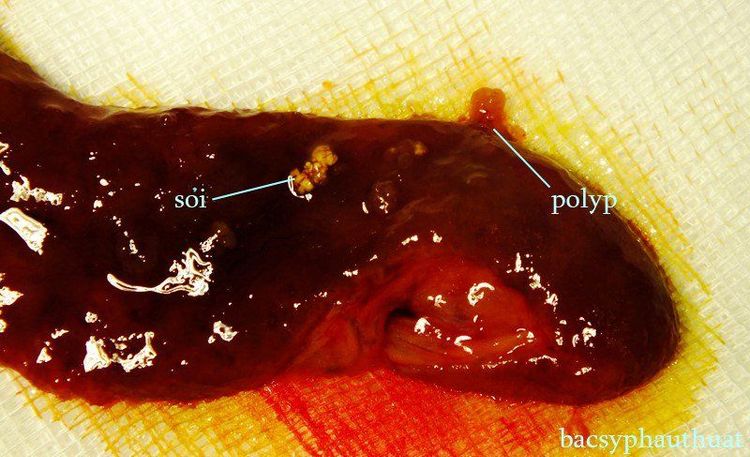 
Sỏi và polyp túi mật
