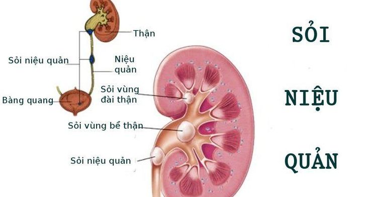 
Sỏi niệu quản
