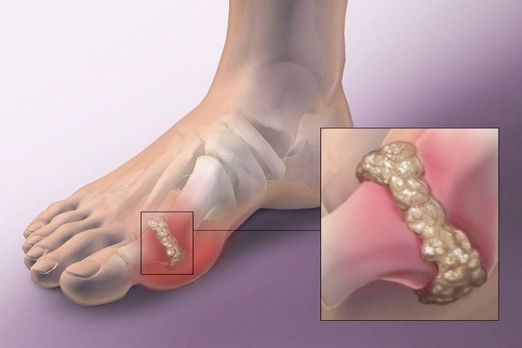 
Gout cũng có thể xảy ra ở đầu gối
