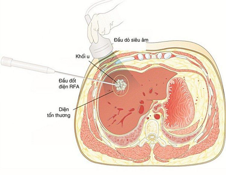 
Đốt u gan bằng sóng cao tần
