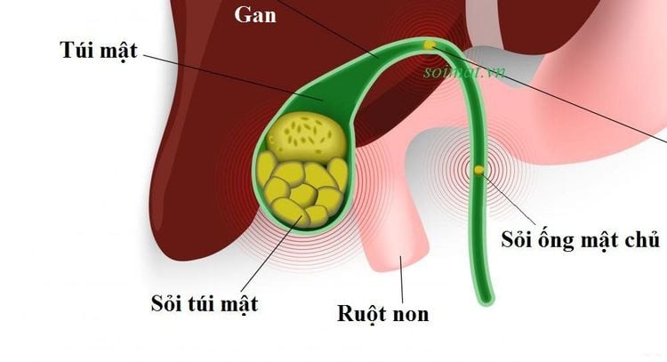 
Sỏi ống mật chủ cần được phát hiện sớm và điều trị kịp thời
