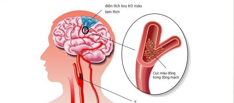 
Thiểu năng tuần hoàn não chỉ là một trong những yếu tố gây nên rối loạn tiền đình
