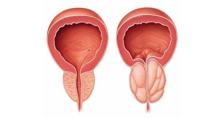 
Khi các nang phát triển to dần sẽ gây ra tình trạng u nang tuyến tiền liệt
