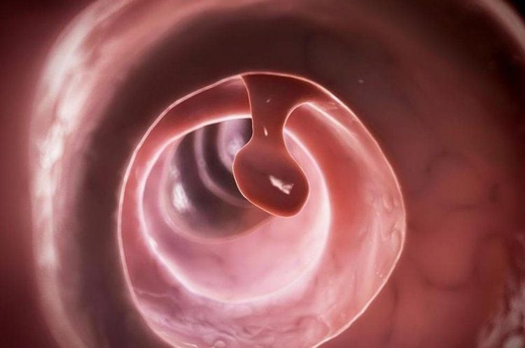 Khả năng tiến triển thành ung thư đại tràng của polyp không tân sinh ít hơn so với các polyp đại tràng khác. 