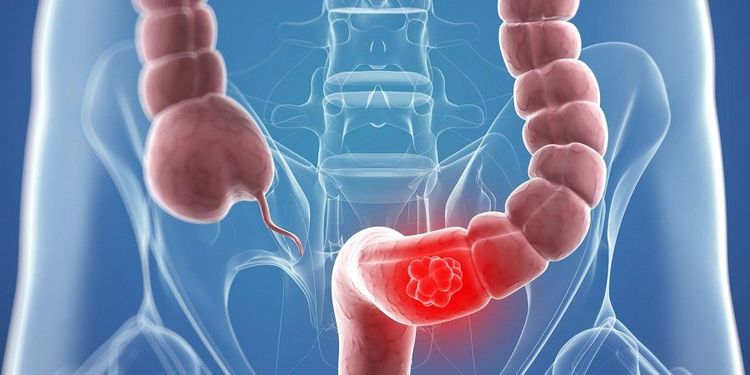 
Đa số polyp đại tràng là lành tính nhưng vẫn có một số khả năng trở thành ác tính
