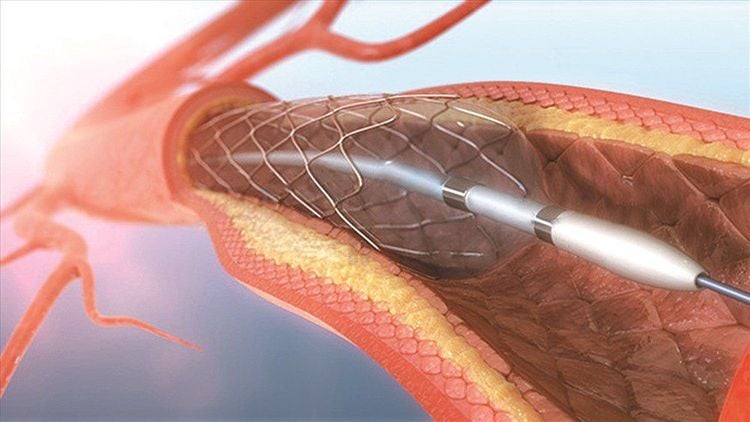 
Stent mạch vành có thể tồn tại vĩnh viễn trong lòng động mạch
