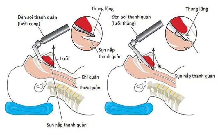 Hình ảnh mổ tả quá trình thực hiện đặt nội khí quản