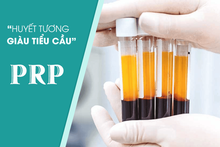 
Phương pháp tiêm huyết tương giàu tiểu cầu được đánh giá là phương pháp điều trị thoái hóa khớp gối an toàn nhất
