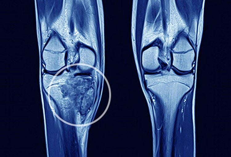 
U xương sụn (Osteochondroma) là dạng u xương lành tính thường gặp nhất ở các xương đang phát triển, xảy ra do sự quá phát của sụn và xương ở gần các đầu xương
