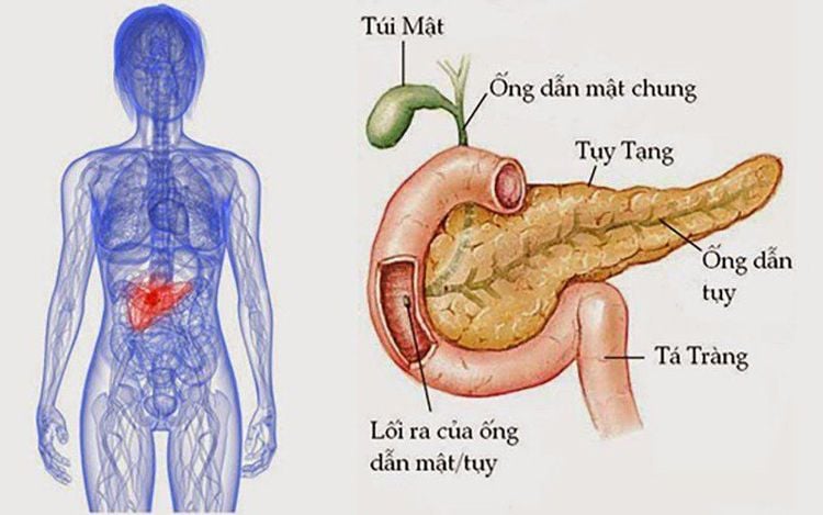 
Viêm tụy gây có thể gây ra hiện tượng vàng da
