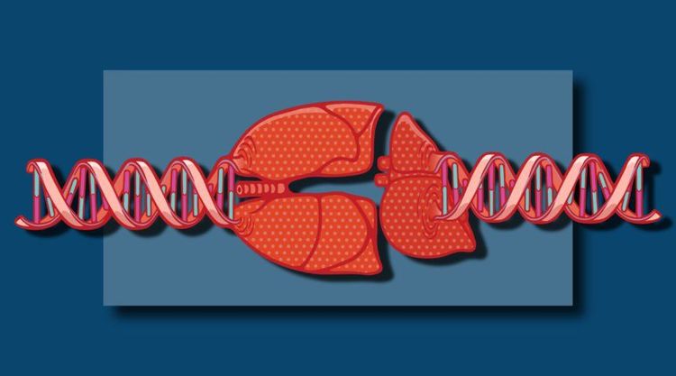 
Thiếu hụt alpha 1 antitrypsin mắc phải được tìm thấy ở các bệnh nhân có hội chứng thiếu hụt protein
