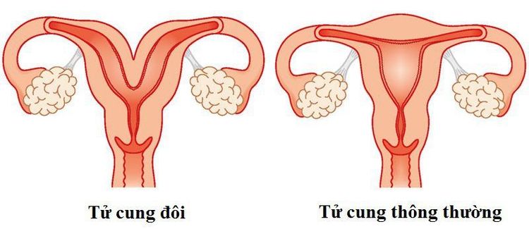 
Vách ngăn dọc trong buồng tử cung
