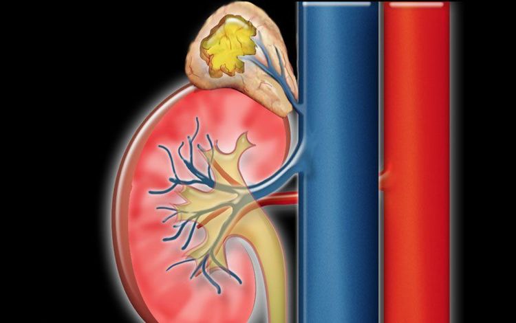 
U tuyến thượng thận > 5cm sẽ gây tăng tiết hormone cần được điều trị sớm
