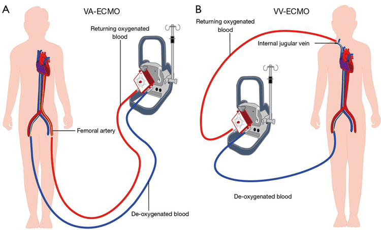 
Kỹ thuật oxy hóa màng ngoài (ECMO)
