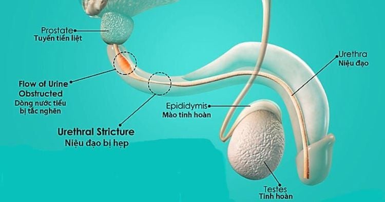 
Bệnh lý niệu đạo ở nam giới
