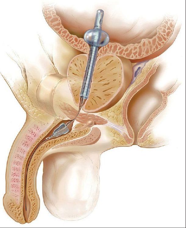 
Điều trị hẹp niệu đạo tái phát bằng phương pháp đặt stent
