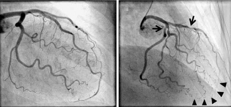 
Chụp động mạch vành giúp phát hiện stent tự tiêu đã hết hay chưa
