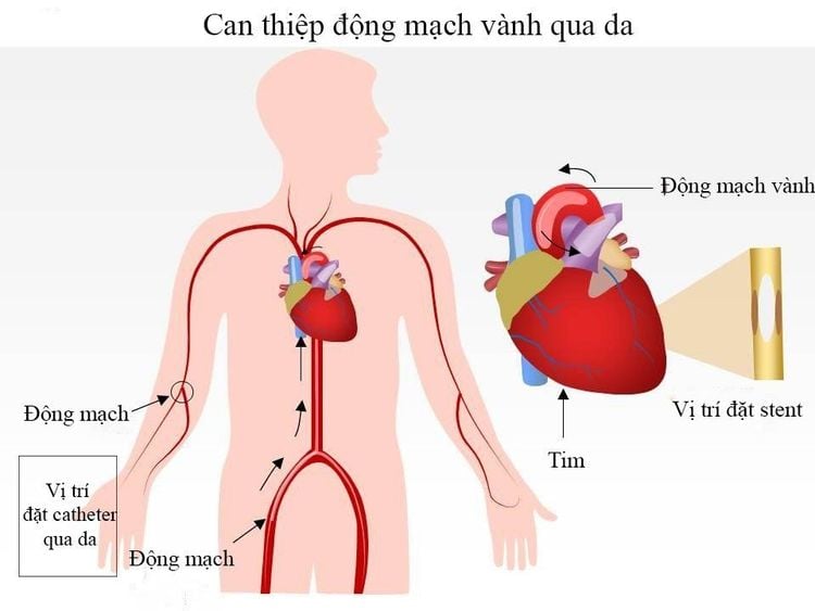 
Hình ảnh mô tả kỹ thuật can thiệp động mạch vành qua da
