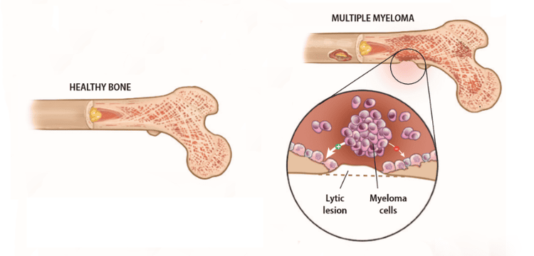 
Healthy bone compared to myeloma bone
