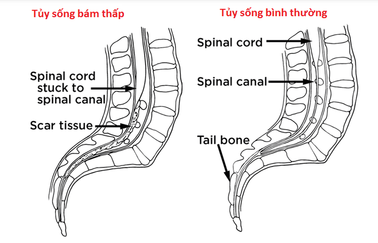 
Hội chứng tủy sống bám thấp là tình trạng rối loạn thần kinh ở cơ thể người
