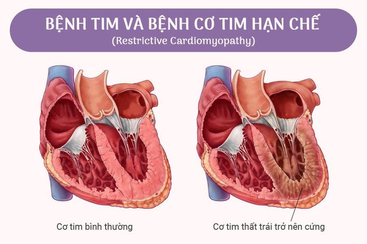 
Hình ảnh bệnh cơ tim hạn chế
