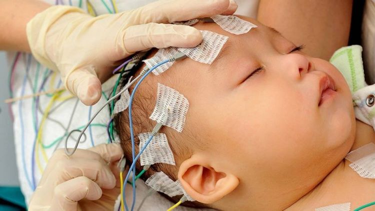 
Điện não đồ (EEG) giúp phát hiện và chẩn đoán bại não ở trẻ
