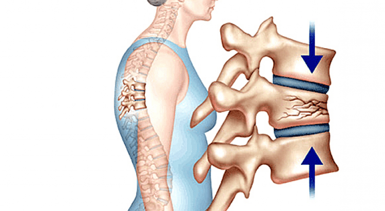 
Xẹp đốt sống ảnh hưởng đến chất lượng cuộc sống của người bệnh
