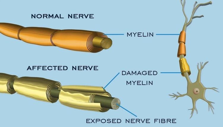 
Hội chứng Guillain - Barre là một rối loạn hiếm gặp, trong đó hệ miễn dịch tự tấn công vào các dây thần kinh của cơ thể
