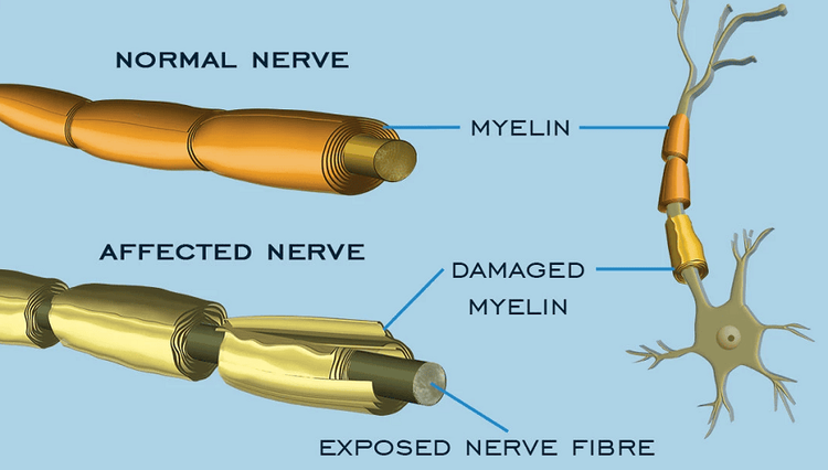 
Hội chứng Guillain Barre
