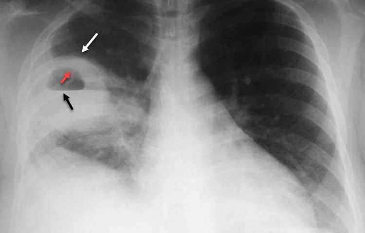 
Chụp X-quang giúp phát hiện ra virus RSV
