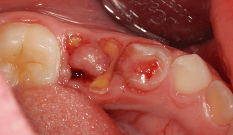 
Hình ảnh u men răng - Ameloblastoma
