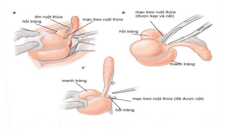 
Hình ảnh minh họa bộc lộ ruột thừa.