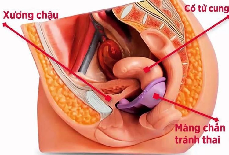 
Hình ảnh mô phỏng vị trí đặt màng ngăn âm đạo
