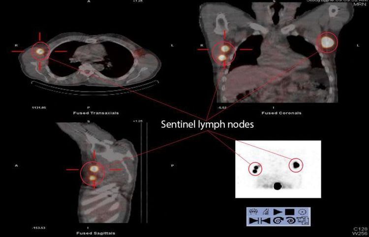 
Hình ảnh minh họa hạch gác trong ung thư vú phát hiện bằng SPECT/CT
