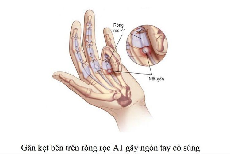 
Hiện tượng ngón tay cò súng
