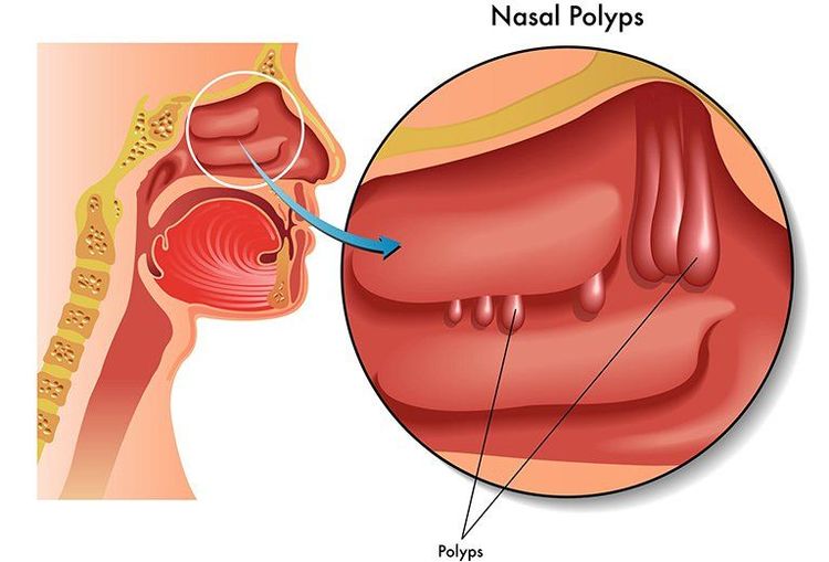 
Polyp mũi là một căn bệnh không quá hiếm gặp, có thể xuất hiện ở mọi đối tượng
