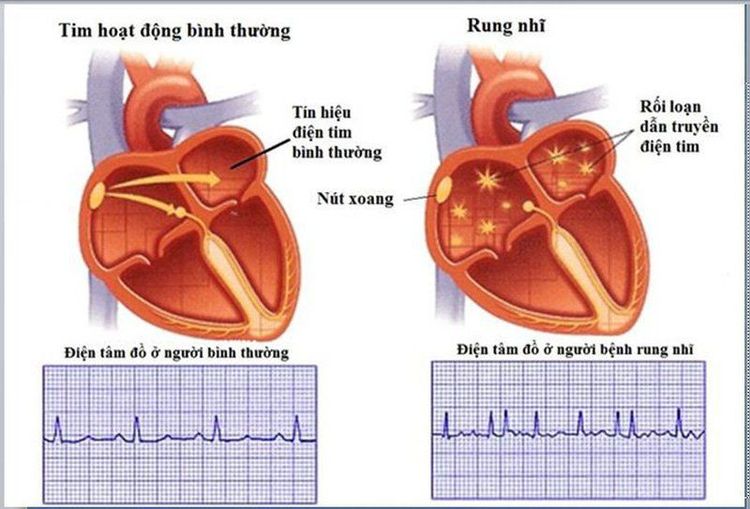 
Rung nhĩ là một trong những biến chứng của hẹp van hai lá gây ra
