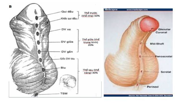 
Các vị trí của lỗ tiểu trong lỗ tiểu thấp
