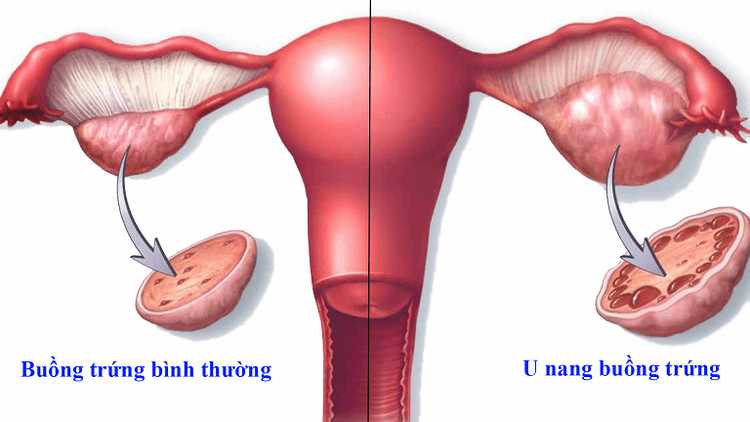 
Tình trạng u nang buồng trứng
