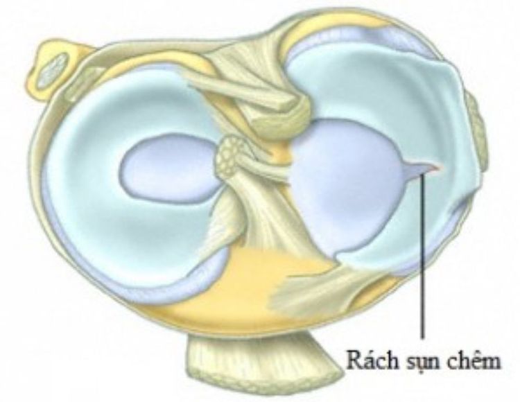 Rách sụn chêm ngoài
